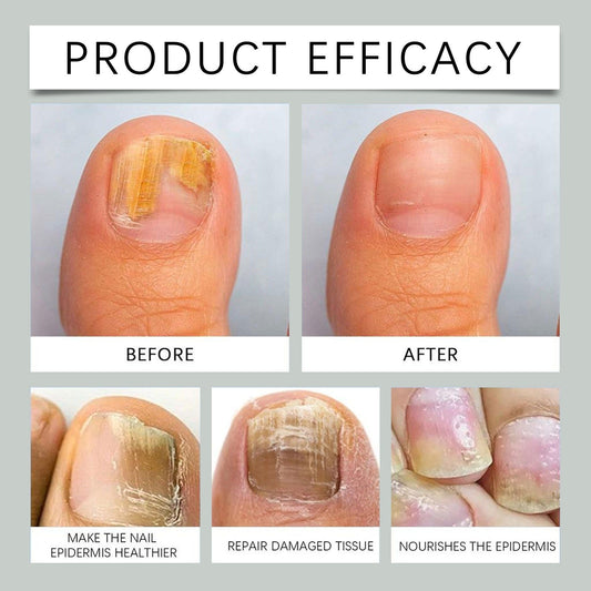 NailDrops 1+1 GRATIS: Vloeibare Nagelschimmelherst Reparatieellende Druppels